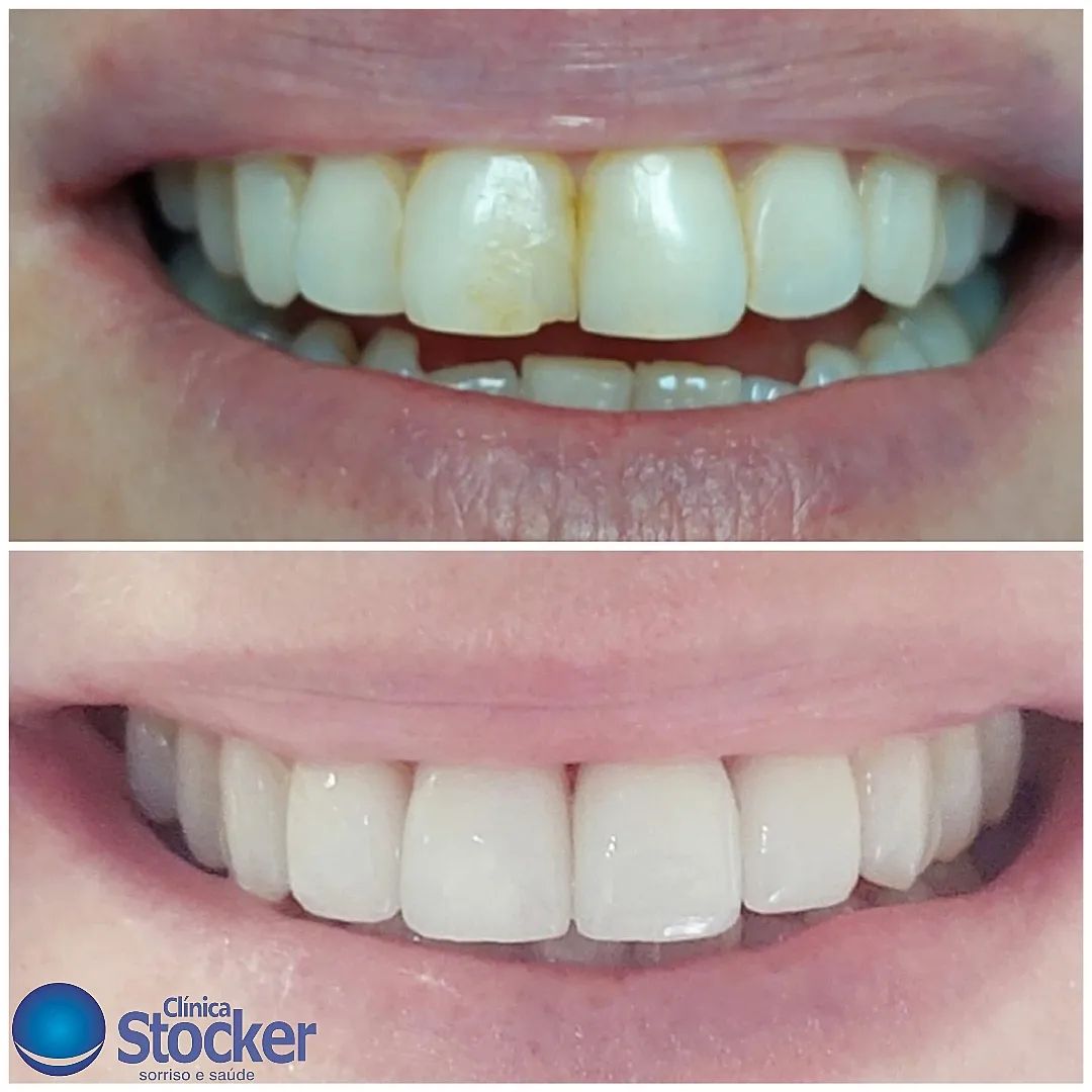 Antes e depois - Facetas estéticas Clínica Stocker