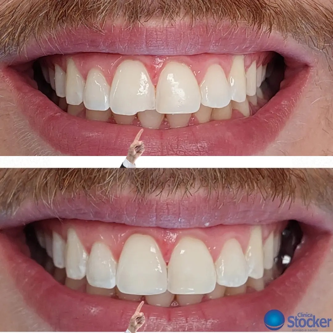 Antes e depois - Transformação de sorriso masculino