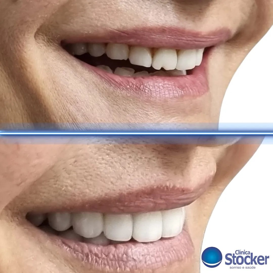 Antes e depois - Reabilitação estética